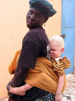 Viziune cu albinism