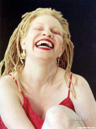viziune cu albinism